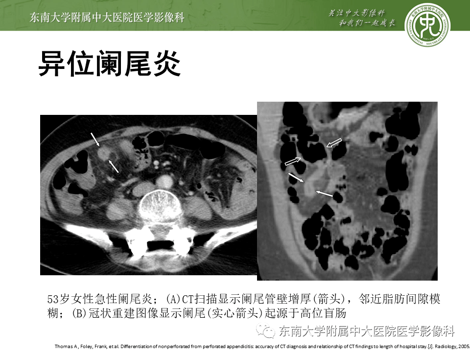 12.31 消化系統疾病——急性壞疽性闌尾炎