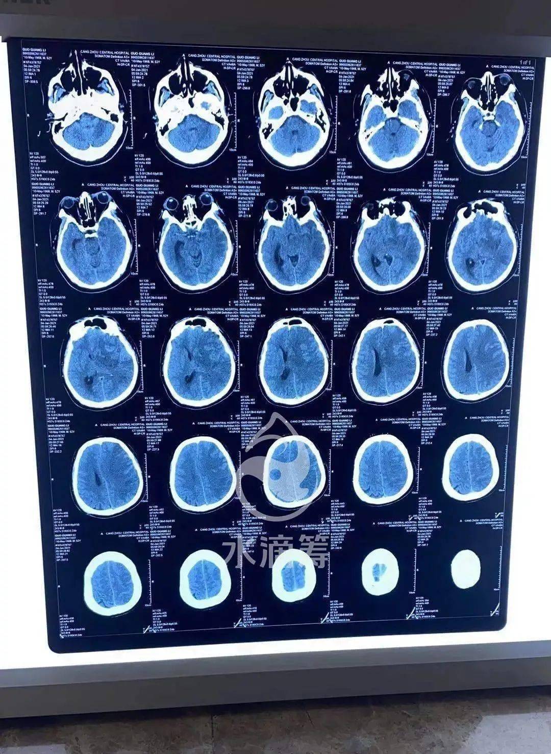 我们赶紧去医院碰头,到了医院各种检查,医生说脑血栓,脑干堵塞,让我们