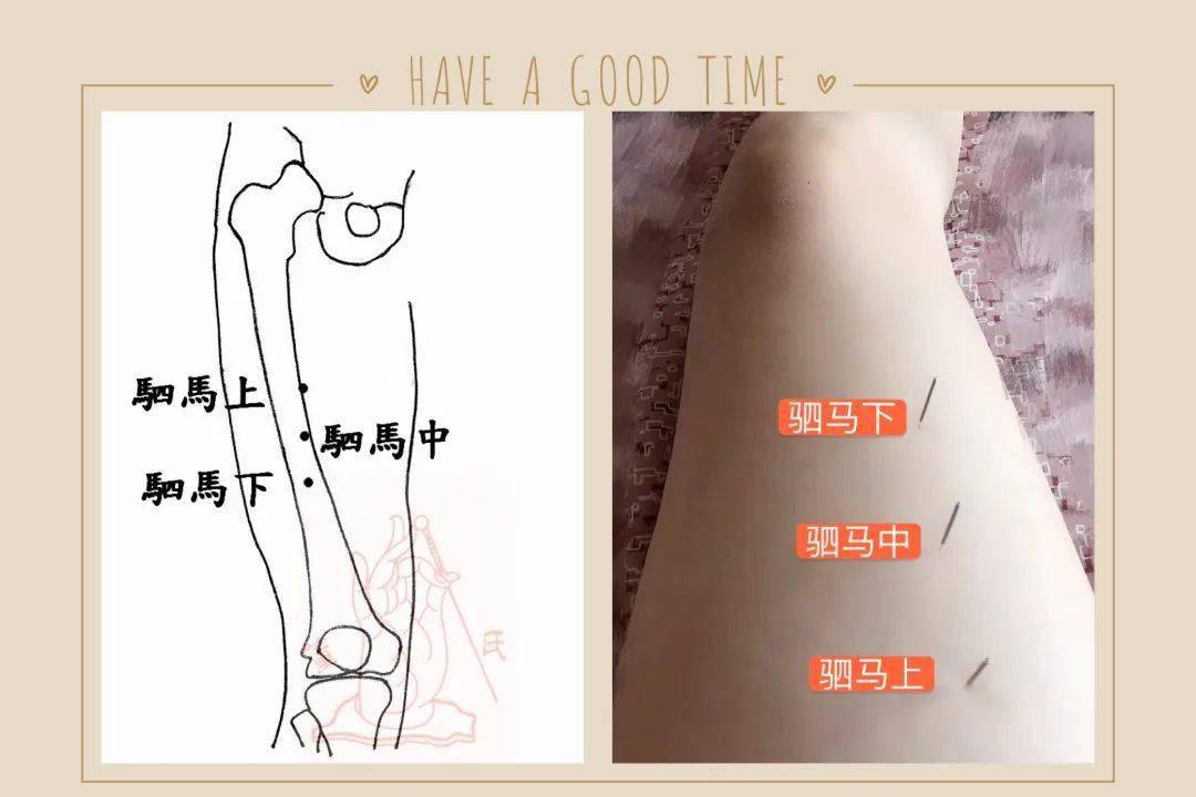 董氏针灸多汗病症症处方: 木穴  止涎  驷马  木斗木留  责任编辑