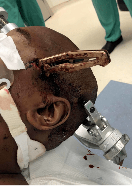 【精选编译】头部低速非弹道穿通伤的多学科治疗_损伤