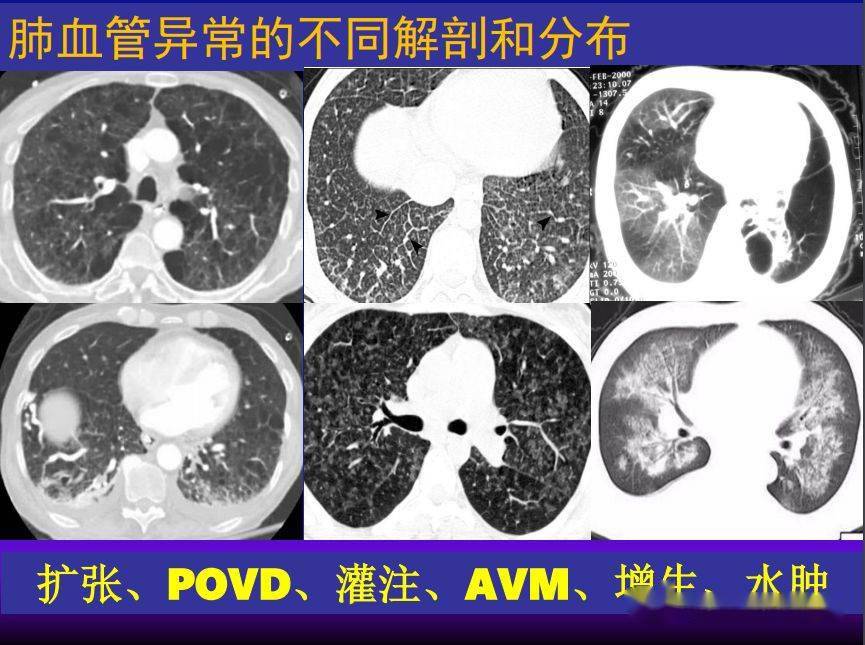 肺間質性疾病的解剖病理影像分析