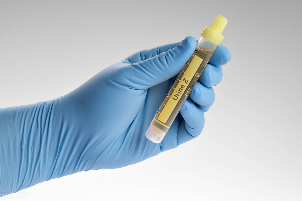 看着尿检报告单子一脸懵?别怕,这篇文章来帮你