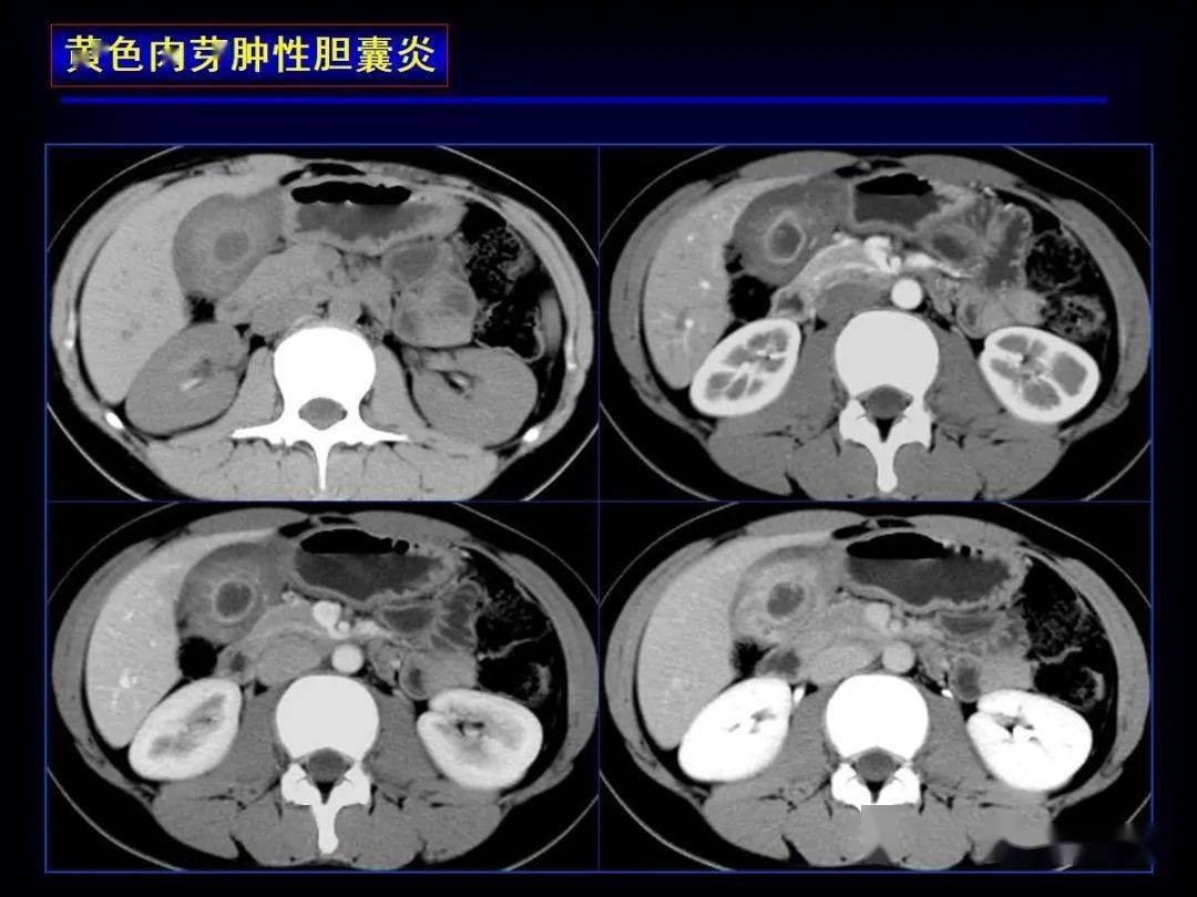 12种胆囊疾病的影像诊断与鉴别