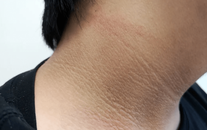 脖子上出现这个东西是糖尿病的表现赶快重视起来