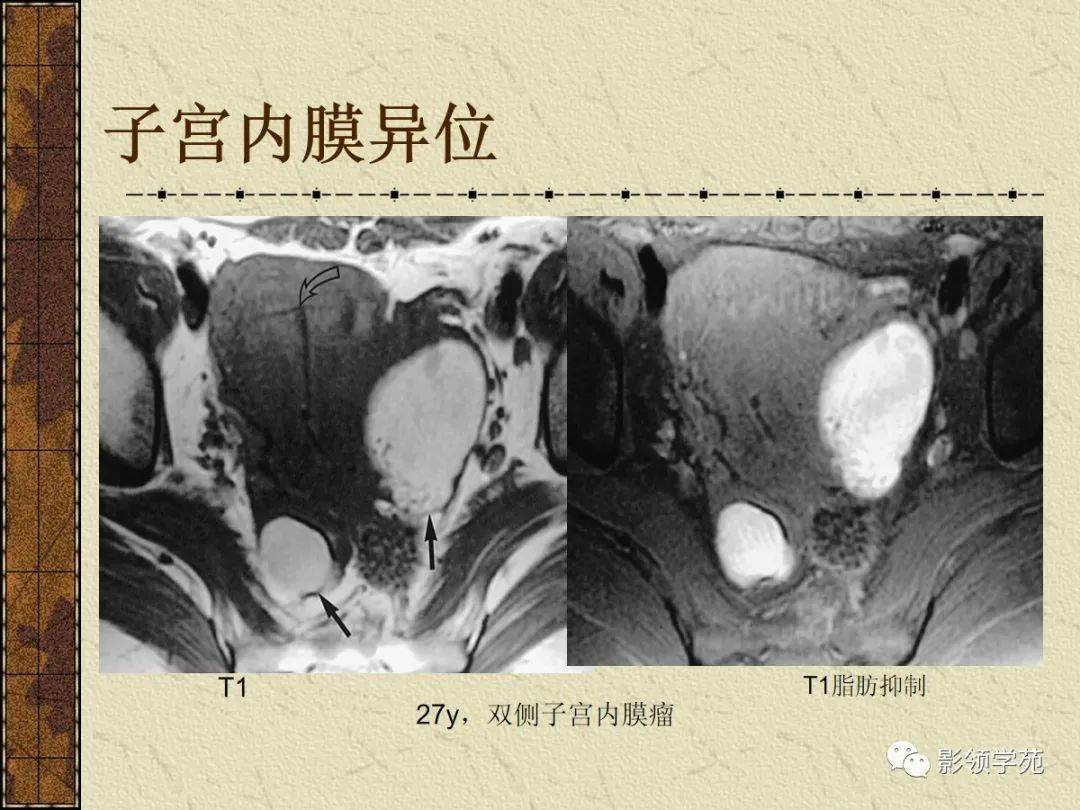 女性盆腔病变的mri诊断