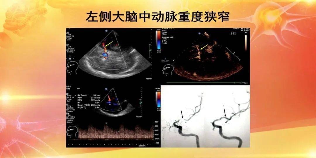 大脑中动脉超声图片