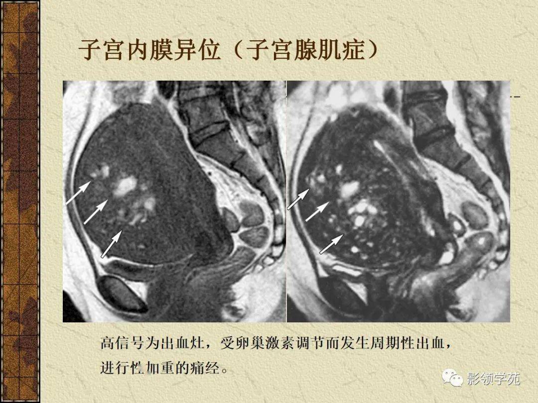 女性盆腔mri圖譜t2wi-sag t1wi-sag(增強)t2wi-sag子宮解剖卵巢及附件