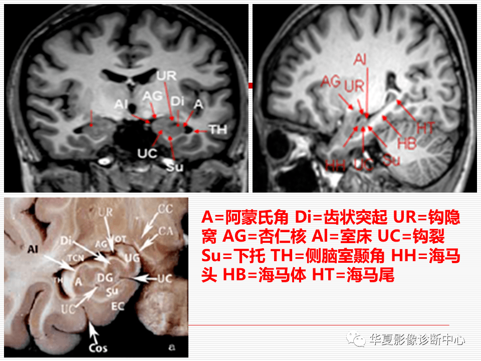 影像复习海马硬化的影像诊断