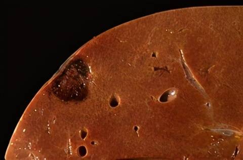 发现肝血管瘤可以不用管吗这份肝血管瘤自述看完你就知道了