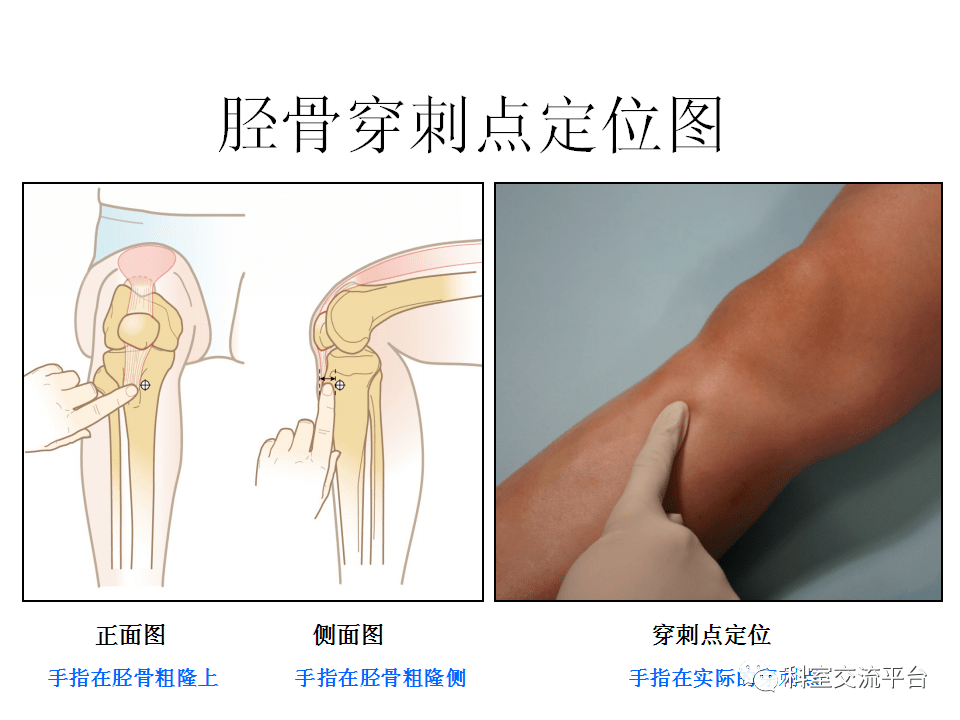 【ppt】骨髓腔内注射系统