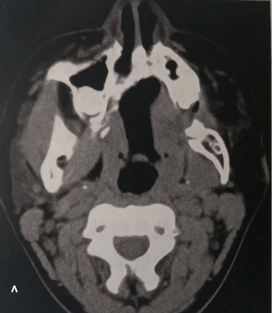 唾液腺缺失,發育不全影像學診斷_腮腺