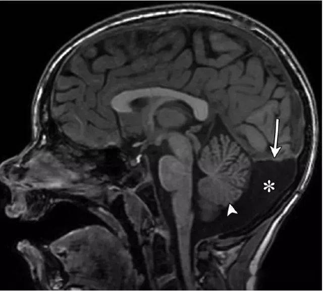 圖 15小腦延髓池蛛網膜囊腫.6歲男孩,伴有癲癇病史.