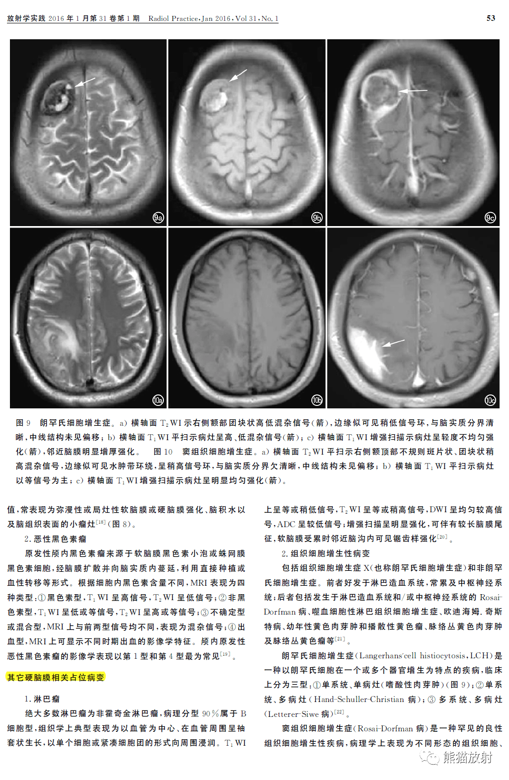 圖文講座丨硬腦膜佔位病變的mri診斷