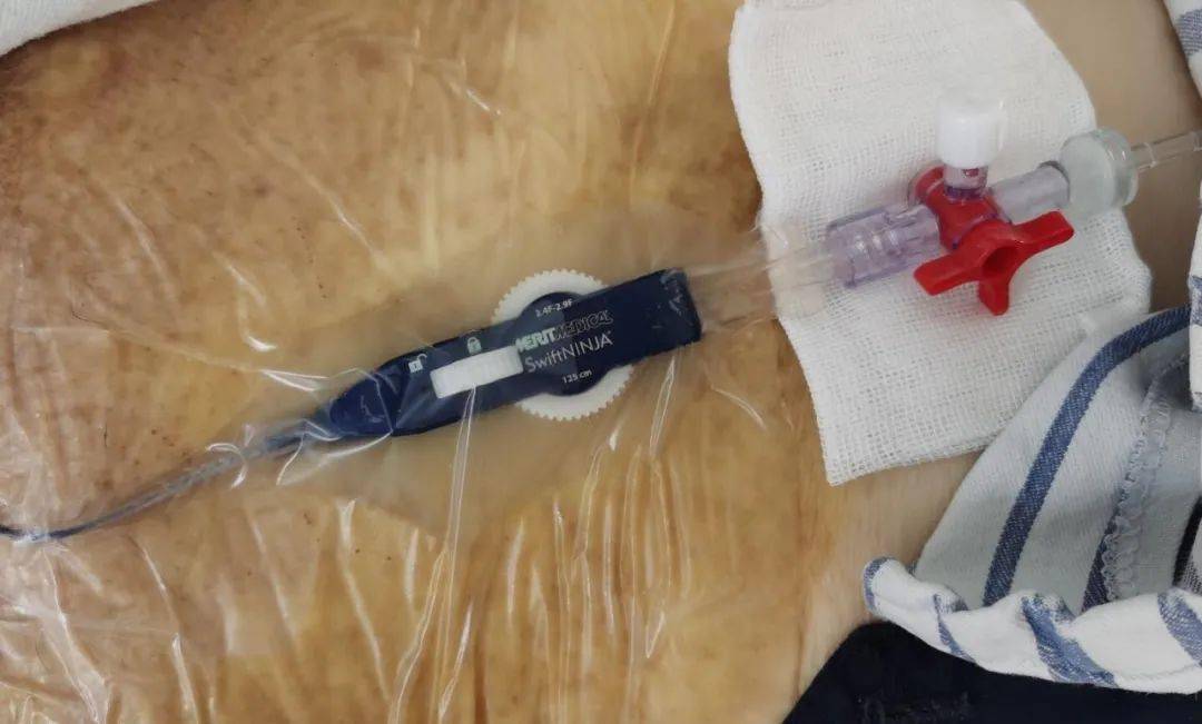 控微导管 | 联合d-tace   haic67为91岁肝癌骨转移老人成功介入手术