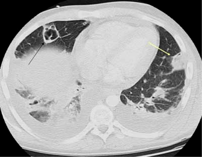 主任问ct显示空洞可能是哪些疾病你怎么回答