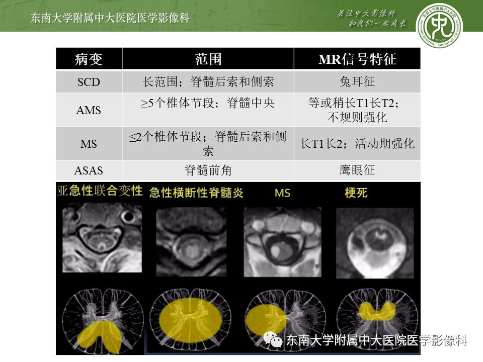 脊髓亚急性联合变性