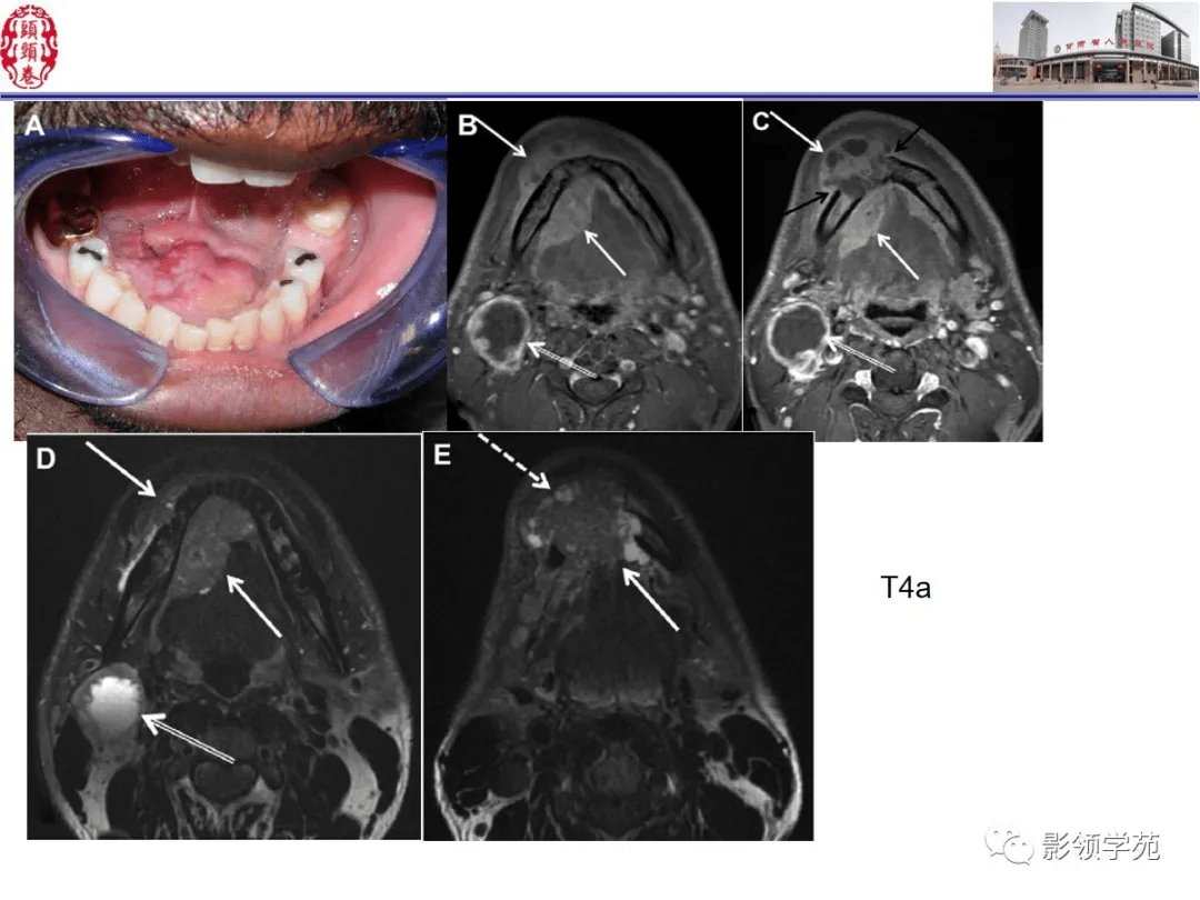 舌骨ct解剖图图片
