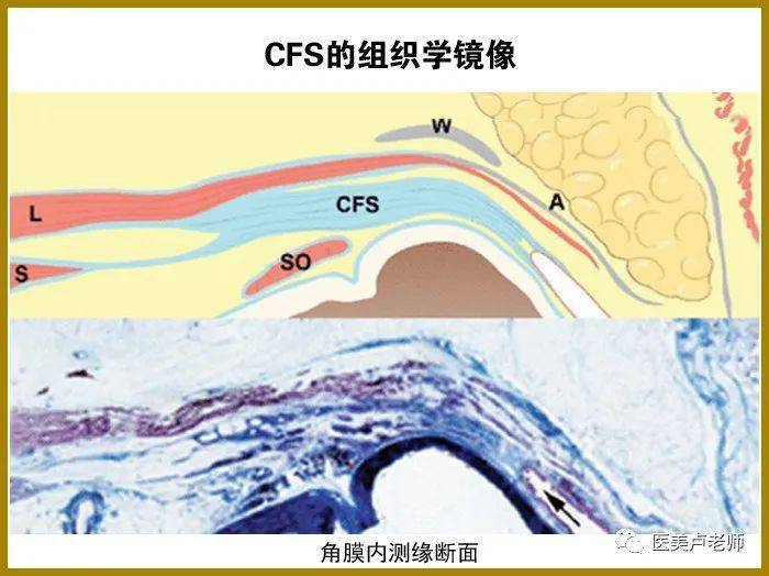 结膜上穹窿联合筋膜鞘(cfs)悬吊术