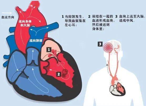 大不同小课堂房颤后最容易危及生命的并发症竟然是它