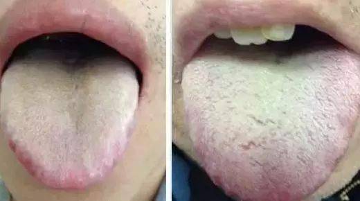 舌苔辨识9种中医体质有配图