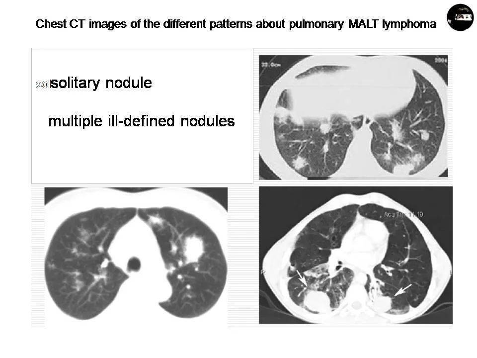 微课堂malt淋巴瘤的诊断与治疗