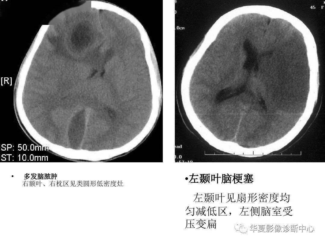 收藏影像醫生必備手把手教你讀懂顱腦ct