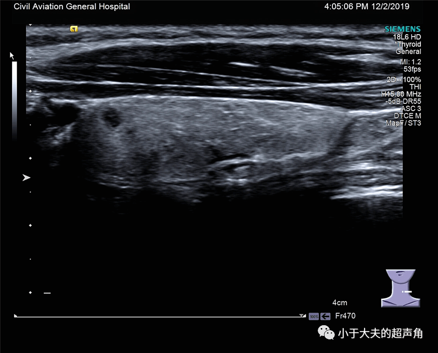 超声随响第47期亚急性甲状腺炎肉芽肿性甲状腺炎