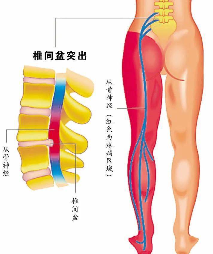 臀部疼怎么办