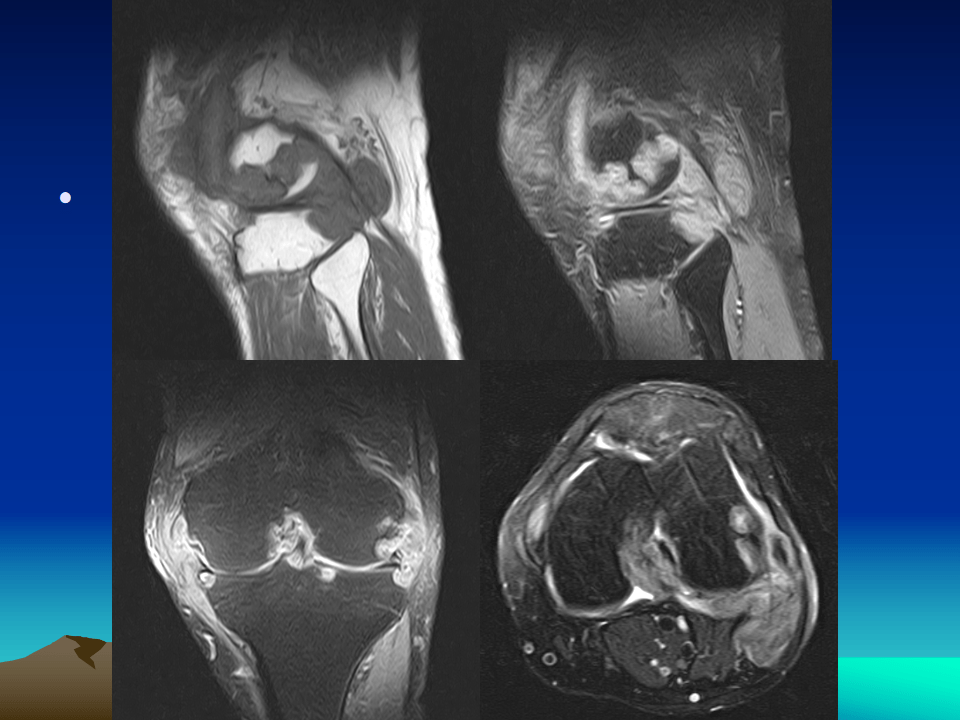膝关节结核的影像学诊断
