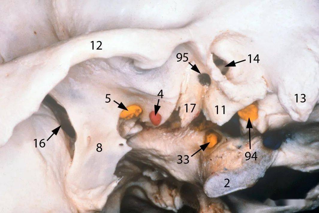 2 枕髁4 棘孔(腦膜中動脈)5 卵圓孔(下頜神經)8 翼突外側板11 鼓板12