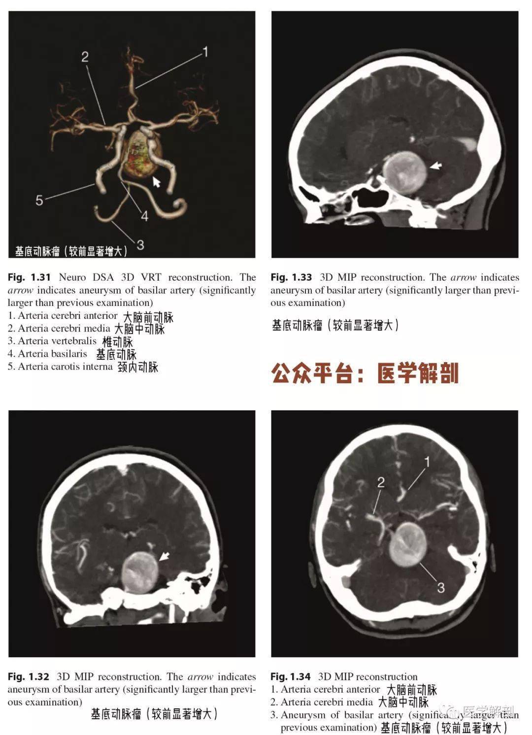 脑cta图谱基底动脉瘤详细解剖及复查