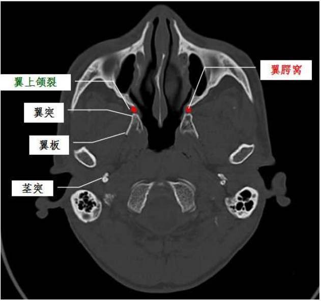 翼顎窩的ct影像解剖