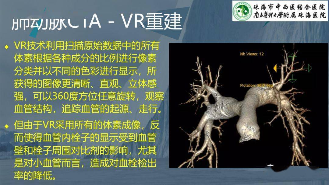 肺动脉cta血管解剖图解图片