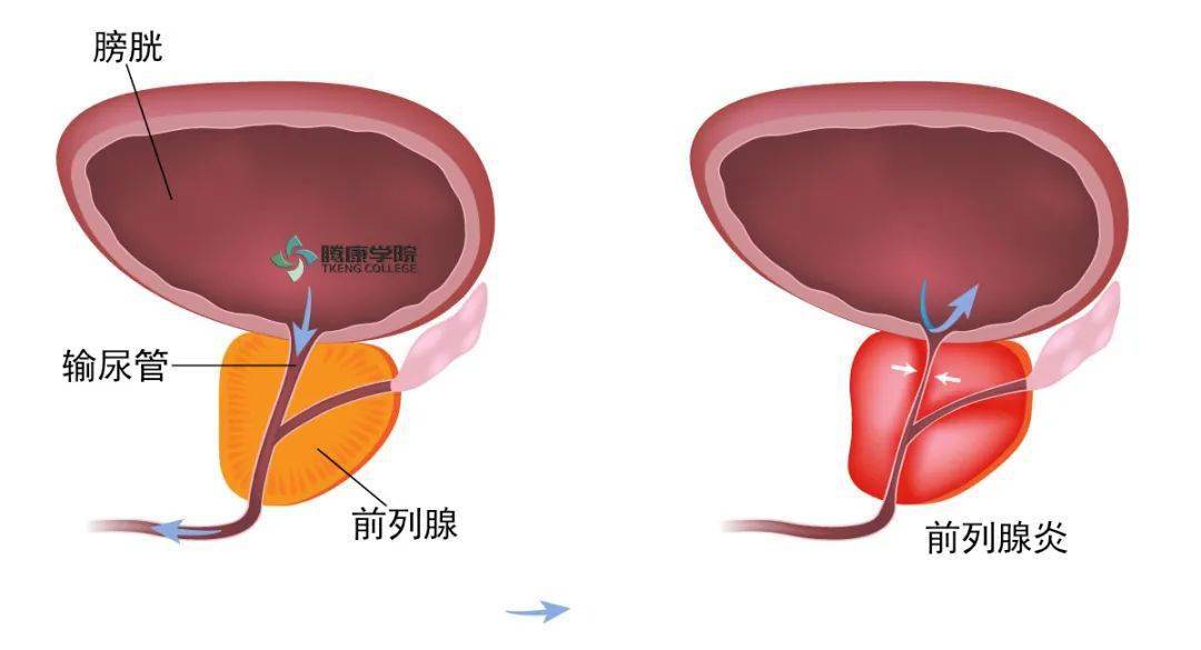 前列腺炎的疼痛部位位于会阴,肛周,耻骨上,下腹部,腹股沟,腰骶部,阴囊