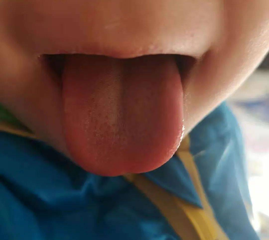 小孩内热舌头图片图片