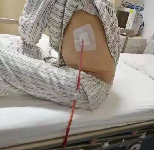 大爷因颈椎病去诊所针灸,竟被扎破肺险丧命!_气胸