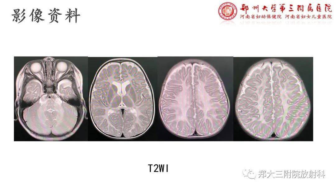 规培生疑难病例佩梅病的影像诊断