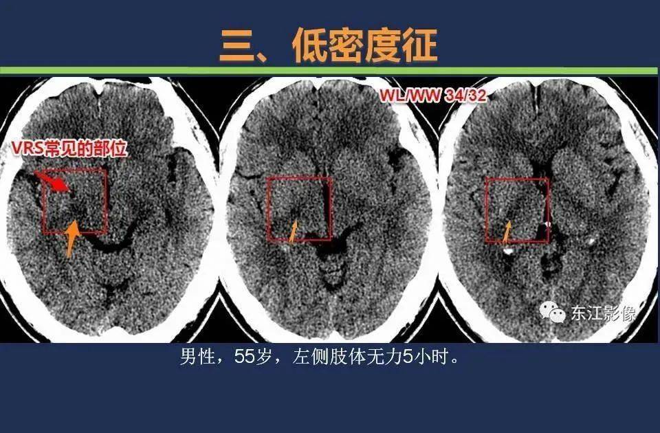 如何根据头颅ct预判超早期脑梗死