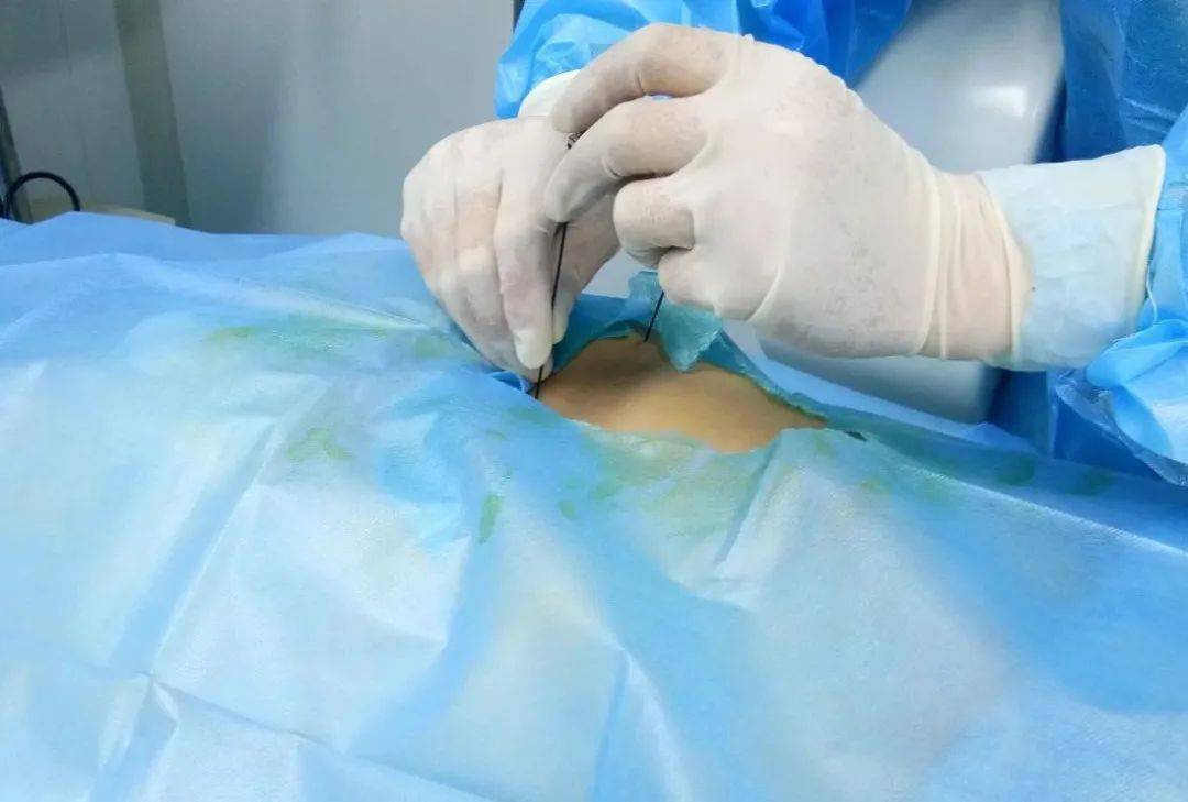 射频消融术4——不开刀治疗"难缠"腰椎间盘突出症