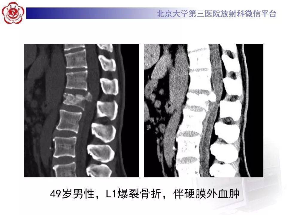 椎体爆裂性骨折影像表现
