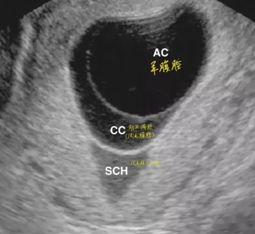 令人揪心的7大早孕超声表现