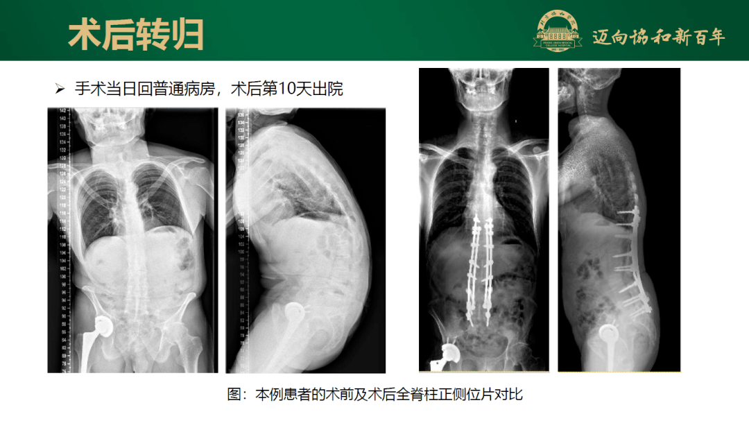 強直性脊柱炎胸腰椎後凸畸形截骨矯形術的麻醉一例_手術