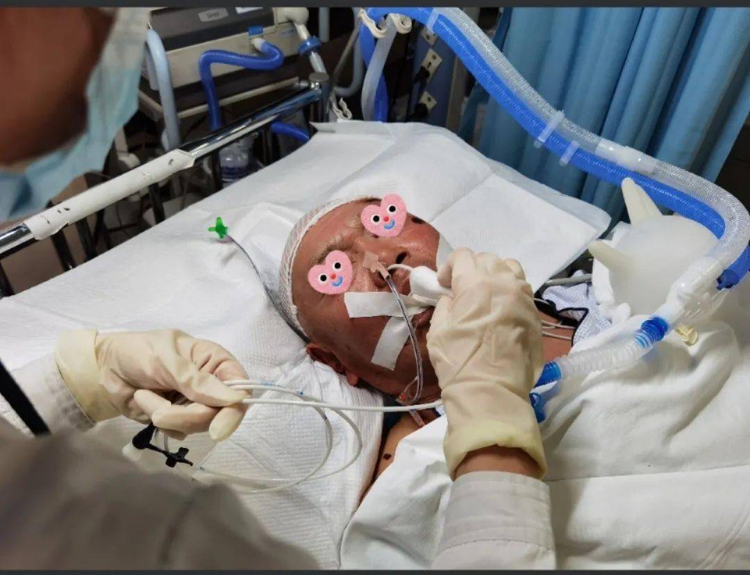 攀附胃管盲插鼻空肠管在神经外科人工气道患者应用技巧分享