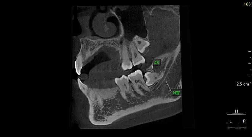 李xx20210130智齿cbct151xxxx1578