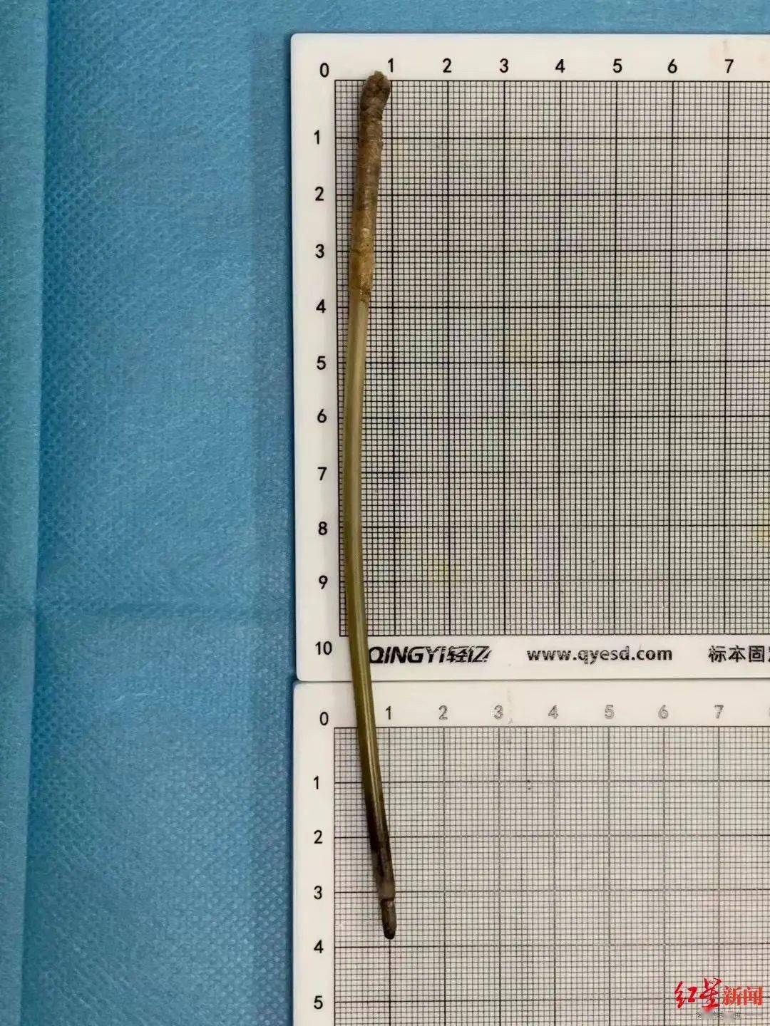 女子体内惊现近15厘米钢钉已逼近肝脏