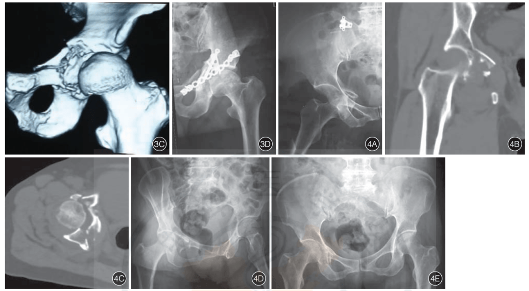 髋臼骨折合并髋关节前脱位的分型及治疗