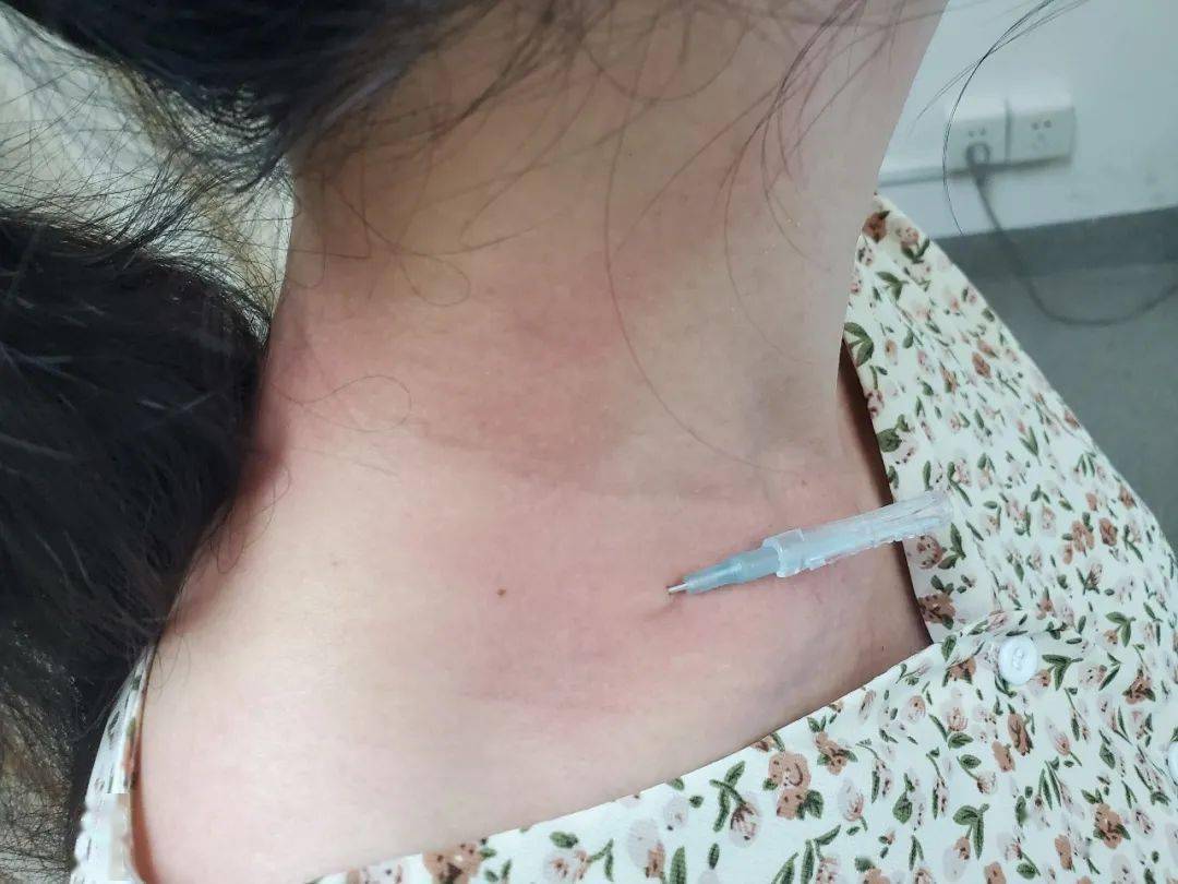 浮针治疗妊娠期周围性面瘫一例