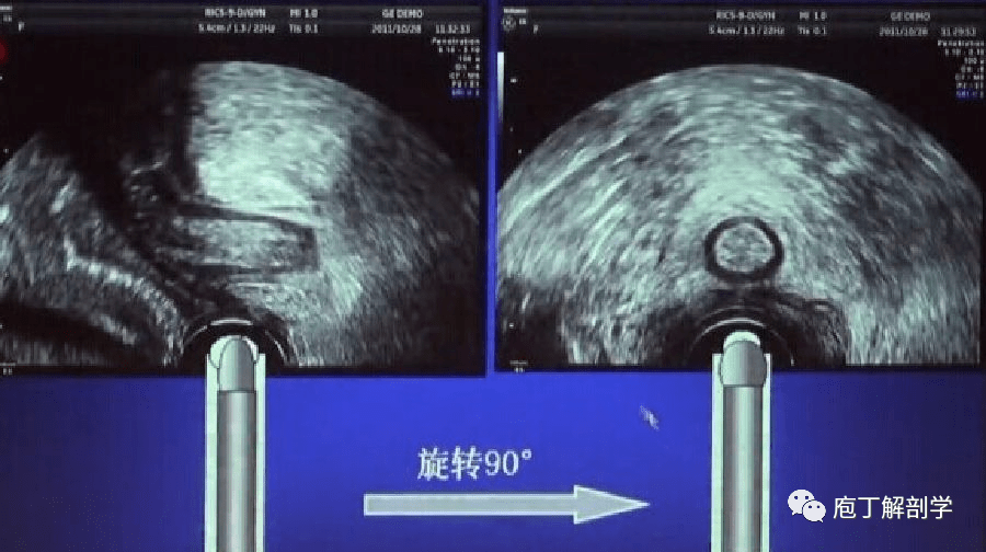 超声时间 | 盆底超声检查