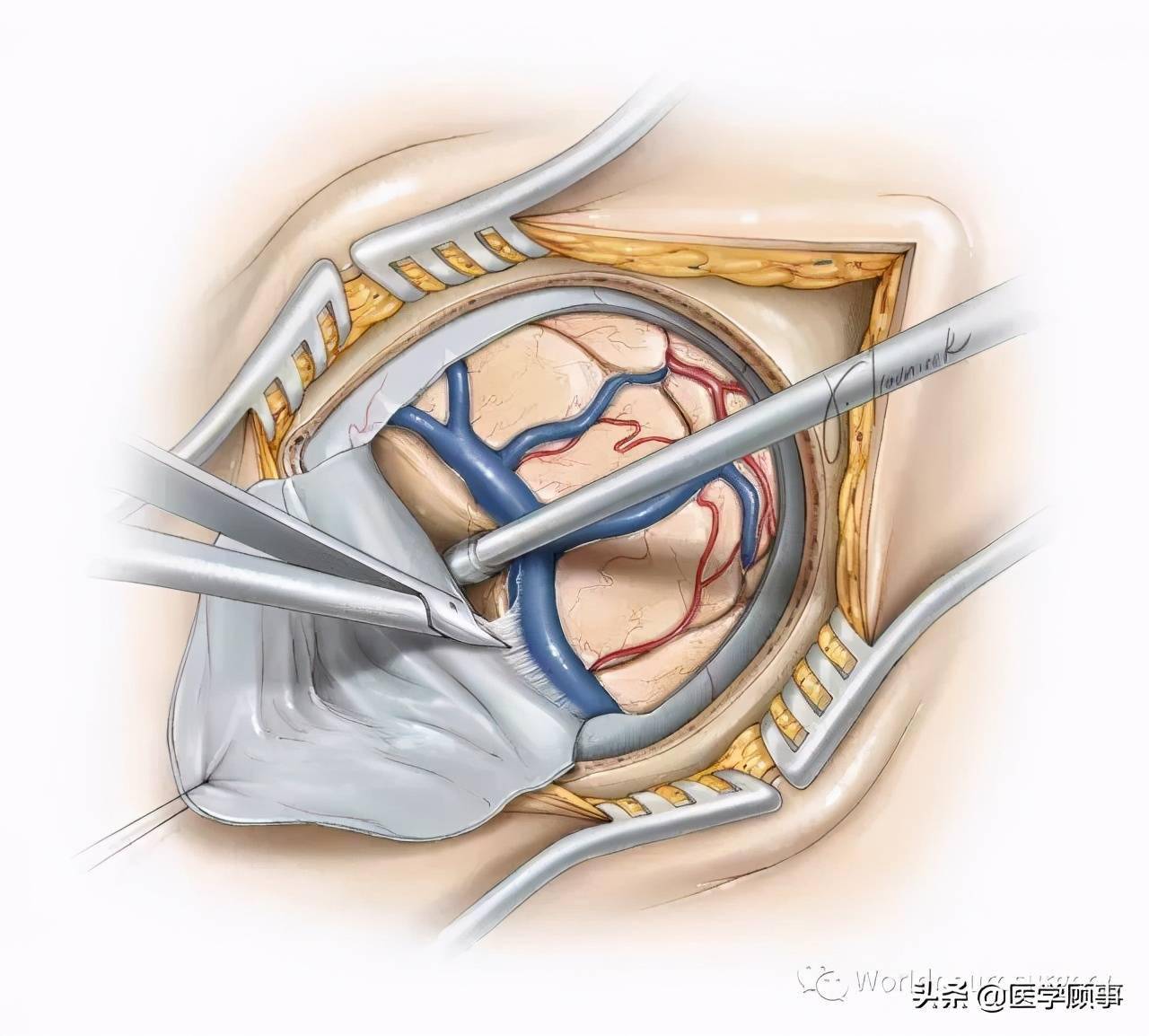 旁矢状窦开颅术