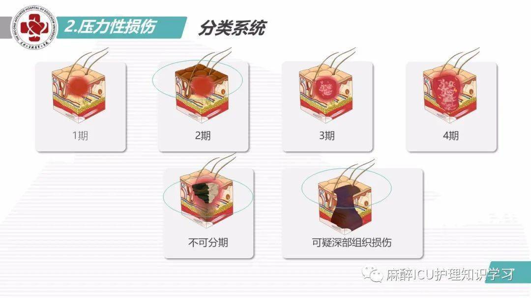 【ppt】结合最新指南谈谈压力性损伤的预防